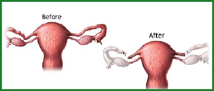 Recanalization Procedure
